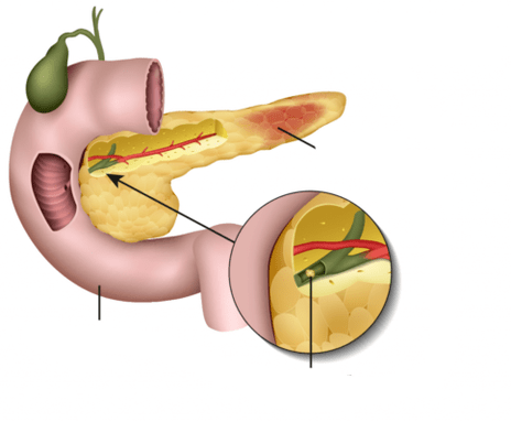 la pancreatitis es la inflamación del páncreas